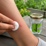 Applying vinegar to mosquito bite